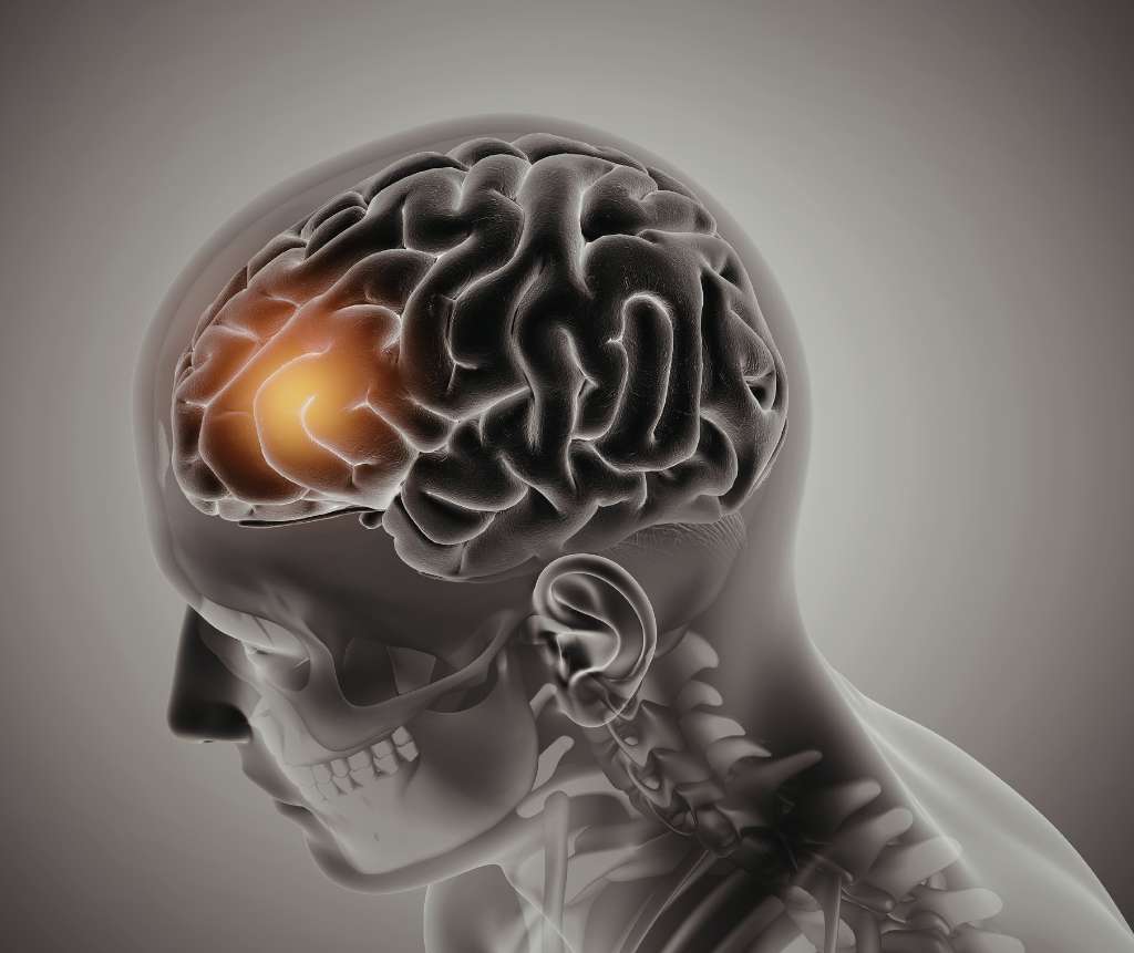 Tumori cerebrali in aree critiche